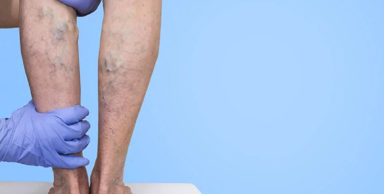 Choroby żył i flebologia – co warto wiedzieć? 