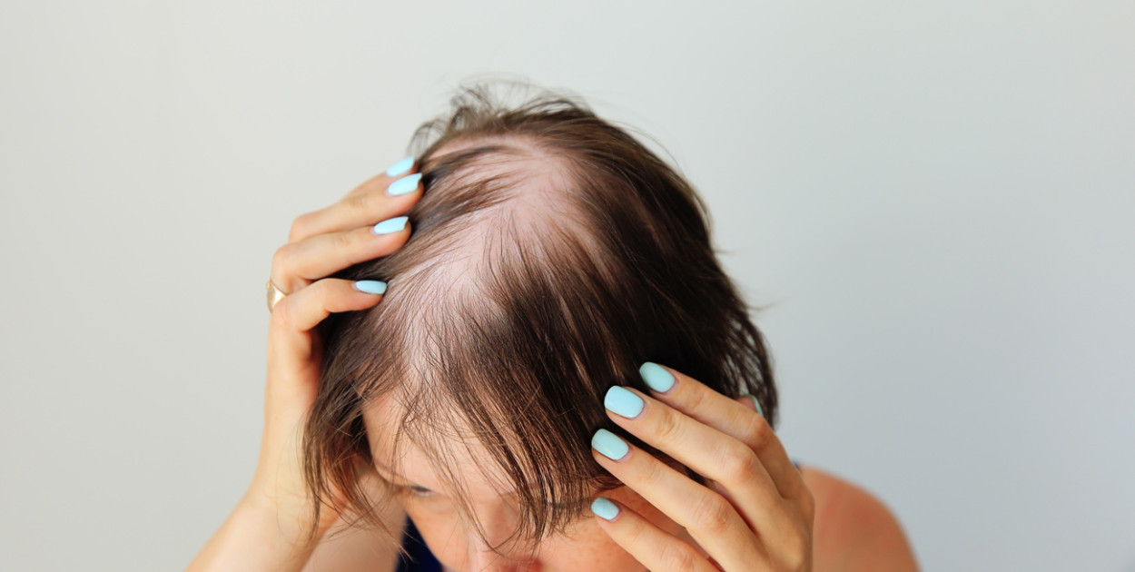 Jak zatrzymać łysienie? Zaskakujące odkrycia medycyny!